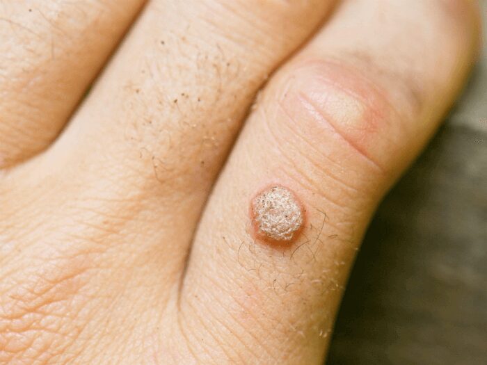 Effect of warts on hands