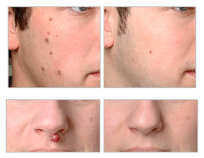 How does Laser Mole Removal Work