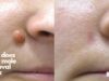 How does laser mole removal work (1)