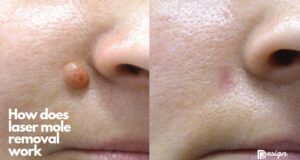 How does laser mole removal work (1)