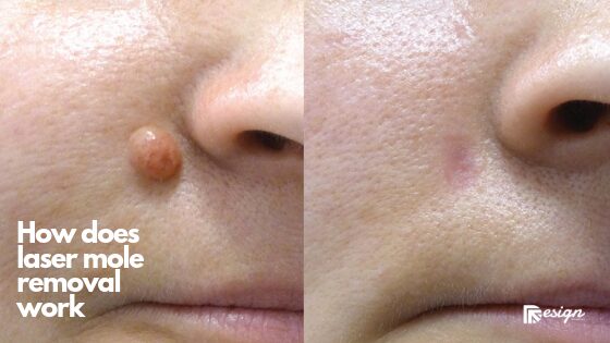 How does laser mole removal work (1)