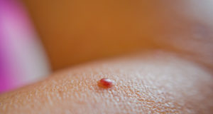 How to Remove Red Moles on Skin