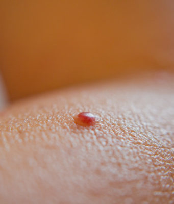 How to Remove Red Moles on Skin