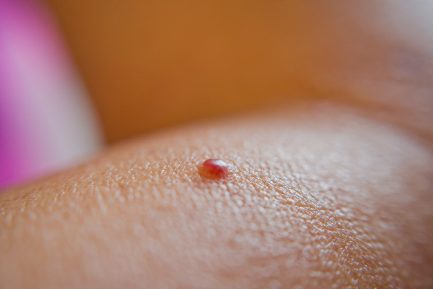 How to Remove Red Moles on Skin