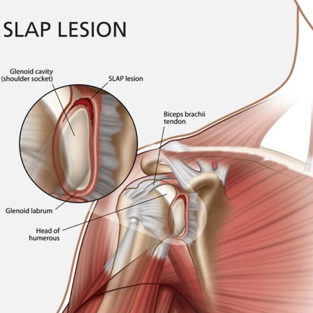 Labrum tear