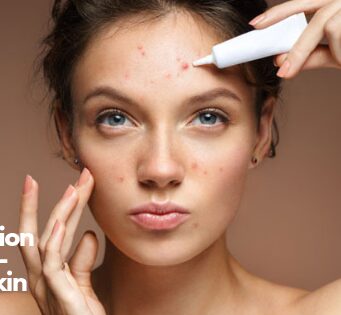 The Best Foundation for Acne-Prone Skin