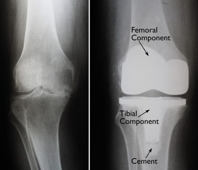How Long Does it Take to Recover After Double Knee Replacement Surgery