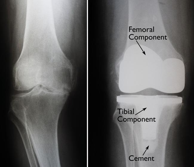 When should I have a double knee replacement done