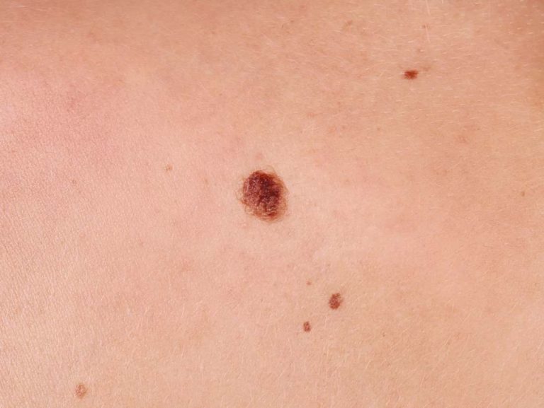 How to Remove Red Moles on Skin - 2024 Guide - Ferguson Action 2024