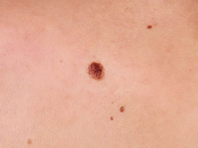 How To Remove Red Moles On Skin 2020 Guide Ferguson Action 2020