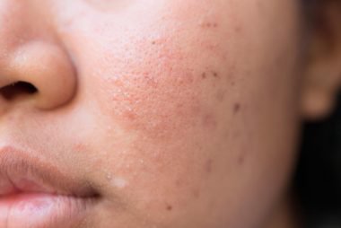 Types of acne scars treated