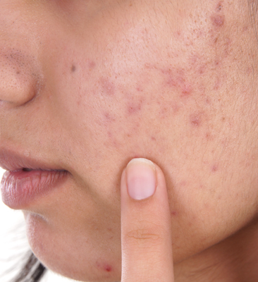 What causes acne and skin discoloration