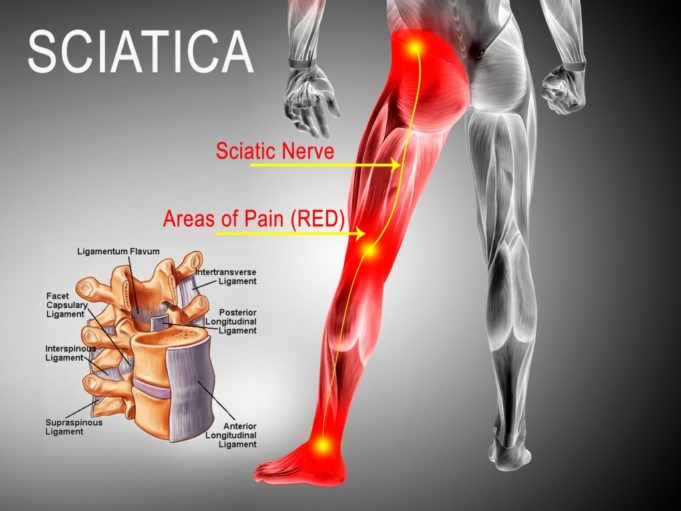 can your mattress sciatica pain